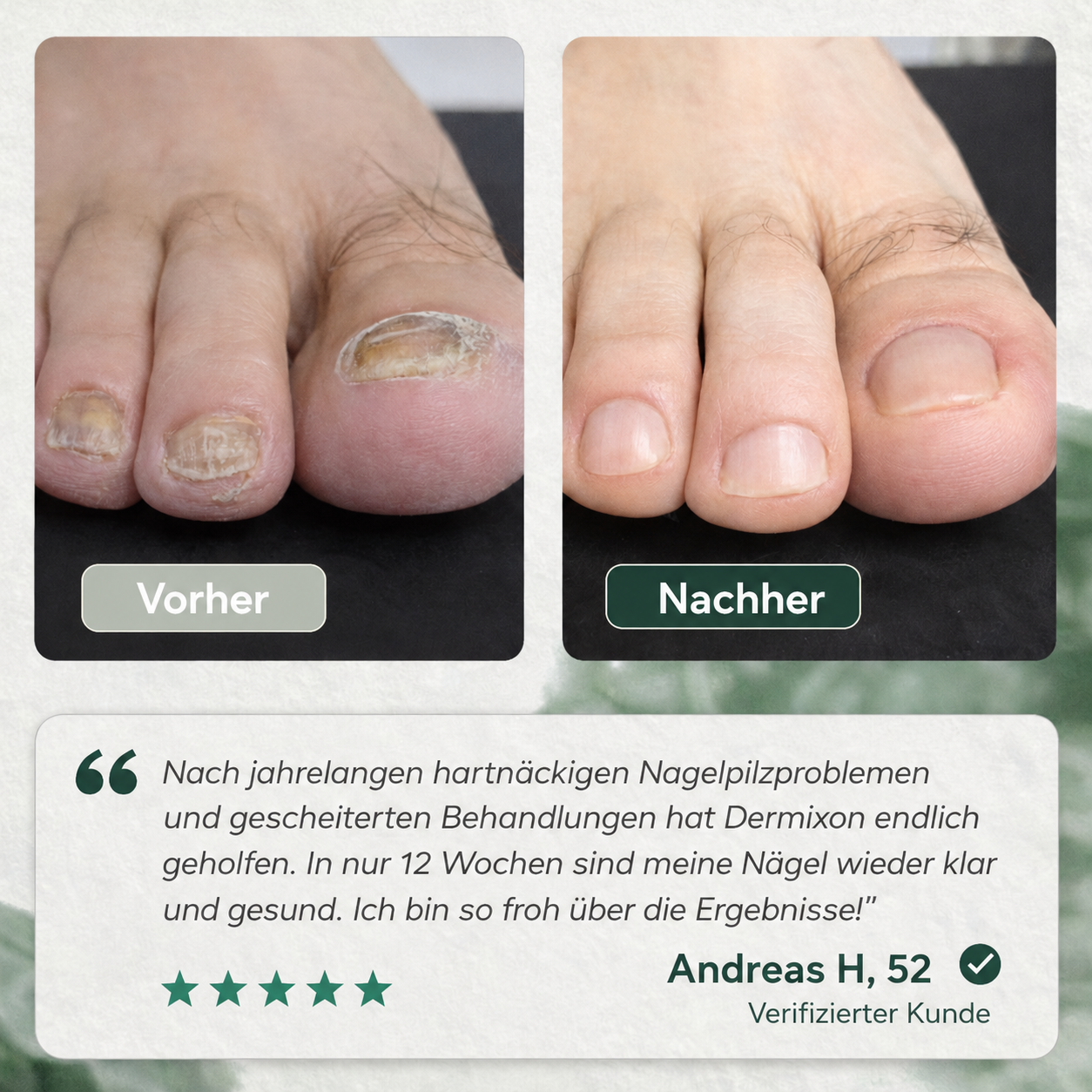 Nagelpilz Präzisionsstift