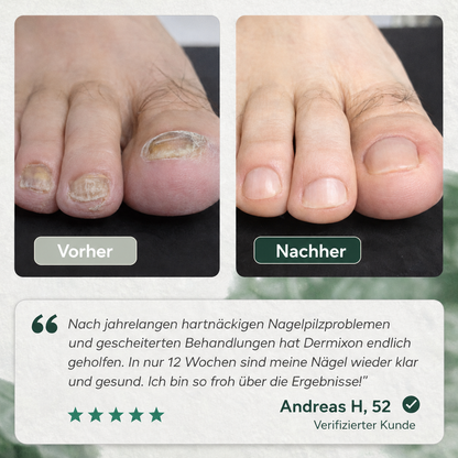 Nagelpilz Präzisionsstift